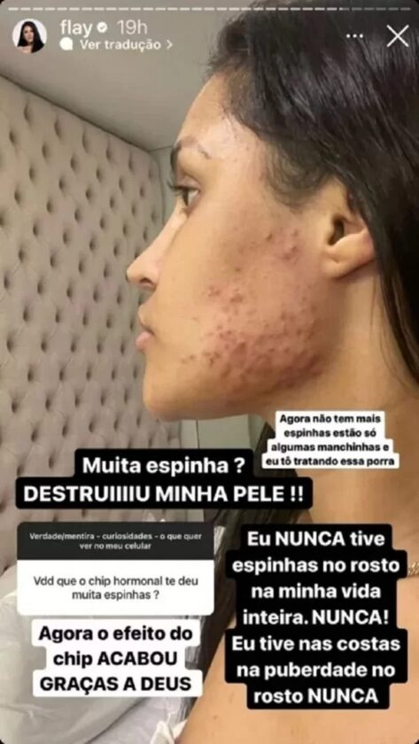 Mulher com o lado do rosto tomado por espinhas